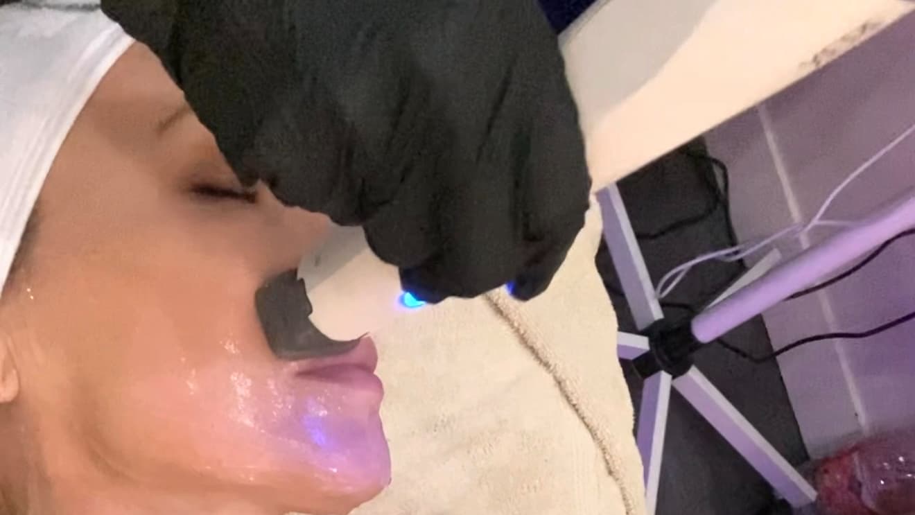 XERF Laser: The Treatment Everyone’s Talking About